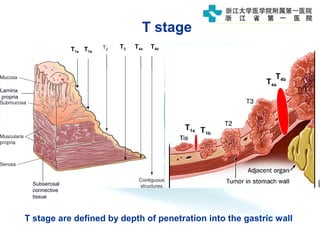 T stage are defined by depth of penetration into the gastric wall
Lamina
propria
T1a T1b
T4a T4bT3
Subserosal
connective
tissue
T1b
T1a
T4a
T4b
T stage
 
