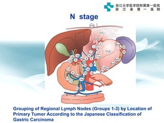 Grouping of Regional Lymph Nodes (Groups 1-3) by Location of
Primary Tumor According to the Japanese Classification of
Gastric Carcinoma
N stage
 