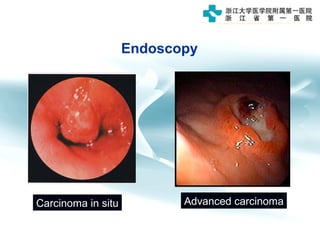 Endoscopy
Carcinoma in situ Advanced carcinoma
 