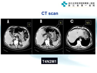 T
N M1
T4N2M1
CT scan
 