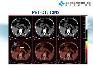PET-CT: T3N2
 
