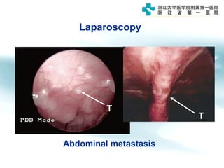 T
T
Laparoscopy
Abdominal metastasis
 