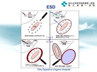 ESD
Oita Digestive Organs Hospital
 