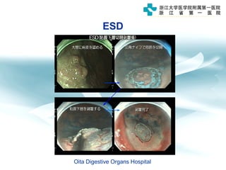 ESD
Oita Digestive Organs Hospital
 