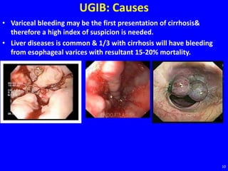 UGIB: Causes
• Variceal bleeding may be the first presentation of cirrhosis&
therefore a high index of suspicion is needed.
• Liver diseases is common & 1/3 with cirrhosis will have bleeding
from esophageal varices with resultant 15-20% mortality.
10
 