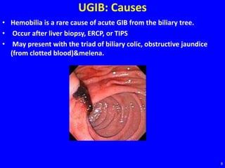 UGIB: Causes
• Hemobilia is a rare cause of acute GIB from the biliary tree.
• Occur after liver biopsy, ERCP, or TIPS
• May present with the triad of biliary colic, obstructive jaundice
(from clotted blood)&melena.
8
 