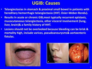 UGIB: Causes
• Telangiectasias in stomach & proximal small bowel in patients with
hereditary hemorrhagic telangiectasia (HHT, Osier-Weber-Rendu).
• Results in acute or chronic GIB,most typically recurrent epistaxis,
mucocutaneous telangiectasia, other visceral involvement (lung,
liver, brain)& a family history of HHT.
• Lesions should not be overlooked because bleeding can be brisk &
mortality high, include varices, pseudoaneurysms& aortoenteric
fistulas.
9
 