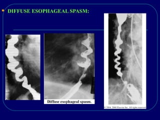  DIFFUSE ESOPHAGEAL SPASM:
 