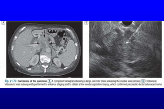 Git 4th pancreatic disorders21