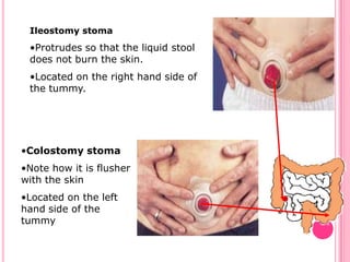 If with chronic diarrhea,  may be evaluated at 8-hour intervals.  13.  Endoscopic ProceduresFibroscopy/ EsophagogastroduodenoscopyAnoscopyProctoscopySigmoidoscopyColonoscopySmall-bowel enteroscopyEndoscopy through ostomy