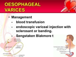 OESOPHAGEAL
VARICES
 • Management
   - blood transfusion
   - endoscopic variceal injection with
     sclerosant or banding.
   - Sengstaken Blakmore tube




                                          13/81
 