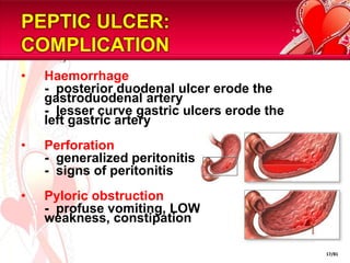 PEPTIC ULCER:
COMPLICATION
•   Haemorrhage
    - posterior duodenal ulcer erode the
    gastroduodenal artery
    - lesser curve gastric ulcers erode the
    left gastric artery
•   Perforation
    - generalized peritonitis
    - signs of peritonitis
•   Pyloric obstruction
    - profuse vomiting, LOW, dehydrated,
    weakness, constipation

                                              17/81
 