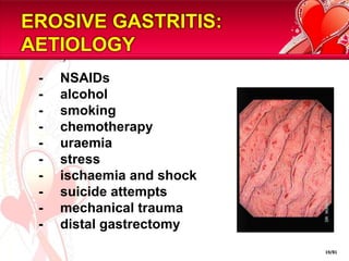EROSIVE GASTRITIS:
AETIOLOGY
 -   NSAIDs
 -   alcohol
 -   smoking
 -   chemotherapy
 -   uraemia
 -   stress
 -   ischaemia and shock
 -   suicide attempts
 -   mechanical trauma
 -   distal gastrectomy
                           19/81
 
