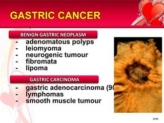GASTRIC CANCER
    BENIGN GASTRIC NEOPLASM
-    adenomatous polyps
-    leiomyoma
-    neurogenic tumour
-    fibromata
-    lipoma
       GASTRIC CARCINOMA
-    gastric adenocarcinoma (90%)
-    lymphomas
-    smooth muscle tumour

                                    21/81
 