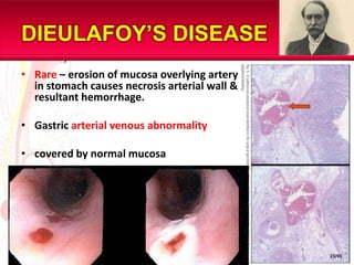 DIEULAFOY’S DISEASE
• Rare – erosion of mucosa overlying artery
  in stomach causes necrosis arterial wall &
  resultant hemorrhage.

• Gastric arterial venous abnormality

• covered by normal mucosa

• profuse bleeding coming from an area of
  apparently normal mucosa.




                                               23/81
 