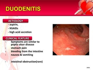 DUODENITIS
    AETIOLOGY
    - aspirin,
    - NSAIDs
    - high acid secretion

CLINICAL FEATURE
-     Symptoms are similar to
      peptic ulcer disease
-     stomach pain
-     bleeding from the intestine
-     nausea & vomiting

-     intestinal obstruction(rare)
                                     24/81
 