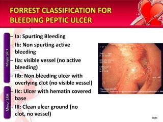 FORREST CLASSIFICATION FOR
            BLEEDING PEPTIC ULCER
            – Ia: Spurting Bleeding
            – Ib: Non spurting active
Major SRH




              bleeding
            – IIa: visible vessel (no active
              bleeding)
            – IIb: Non bleeding ulcer with
              overlying clot (no visible vessel)
            – IIc: Ulcer with hematin covered
Minor SRH




              base
            – III: Clean ulcer ground (no
              clot, no vessel)                     30/81
 