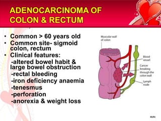 ADENOCARCINOMA OF
 COLON & RECTUM
• Common > 60 years old
• Common site- sigmoid
  colon, rectum
• Clinical features:
   -altered bowel habit &
  large bowel obstruction
   -rectal bleeding
   -iron deficiency anaemia
   -tenesmus
   -perforation
   -anorexia & weight loss

                              40/81
 