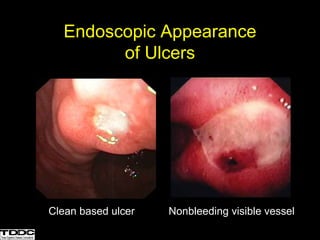 Endoscopic Appearance
of Ulcers
Clean based ulcer Nonbleeding visible vessel
 