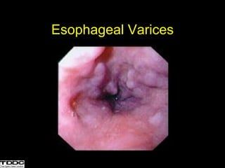 Esophageal Varices
 