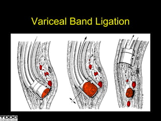 Variceal Band Ligation
 