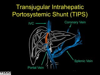 Transjugular Intrahepatic
Portosystemic Shunt (TIPS)
IVC
Portal Vein
Splenic Vein
Coronary Vein
 