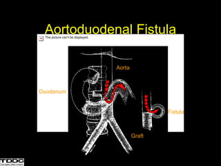 Aortoduodenal Fistula
The picture can't be displayed.
The picture can't be displayed.
The picture can't be displayed.
The picture can't be displayed.
Aorta
Duodenum
Graft
Fistula
 