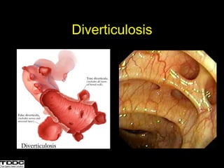 Diverticulosis
 