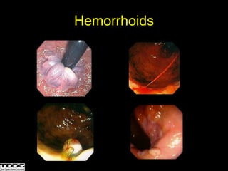 Hemorrhoids
 