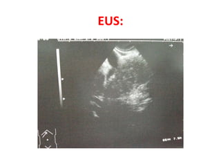EUS: 