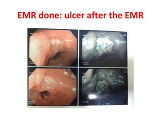 EMR done: ulcer after the EMR 