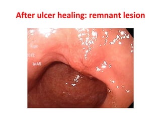 After ulcer healing: remnant lesion 