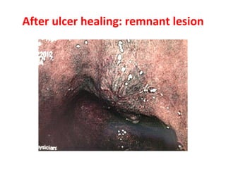 After ulcer healing: remnant lesion 