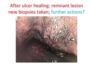 After ulcer healing: remnant lesion new biopsies taken;  further actions? 