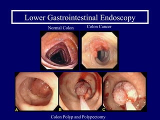 Lower Gastrointestinal Endoscopy Normal Colon Colon Cancer Colon Polyp and Polypectomy 