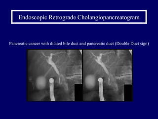 Endoscopic Retrograde Cholangiopancreatogram Pancreatic cancer with dilated bile duct and pancreatic duct (Double Duct sign) 