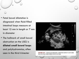 Fetal Intestinal Rotation Embryology of the Gastrointestinal Tract with Radiological Correlation ...