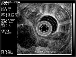Celiac LN in T3 Esophageal Cancer   