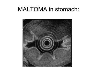 MALTOMA in stomach: 
