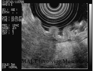 MALTOMA in stomach: MALT involving Muscularis 
