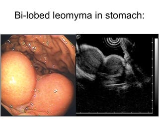 Bi-lobed leomyma in stomach: MALT involving Muscularis 