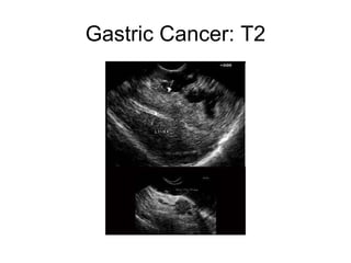 Gastric Cancer: T2 