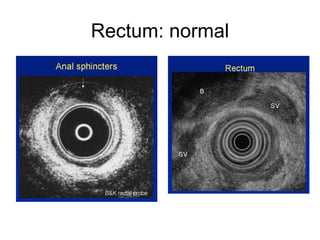 Rectum: normal 