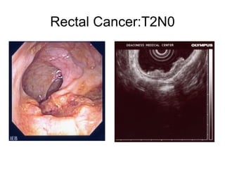 Rectal Cancer:T2N0 