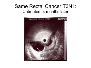 Same Rectal Cancer T3N1: Untreated, 4 months later 