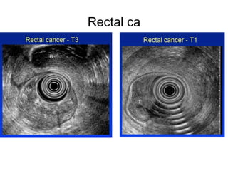 Rectal ca 