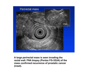 A large perirectal mass is seen invading the rectal wall. FNA biopsy (Pentax FG-32UA) of the mass confirmed recurrence of prostatic cancer (inset).  