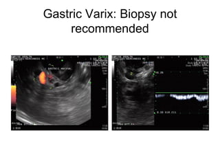 Gastric Varix: Biopsy not recommended 