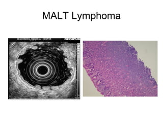 MALT Lymphoma 