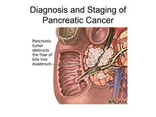 Diagnosis and Staging of Pancreatic Cancer 
